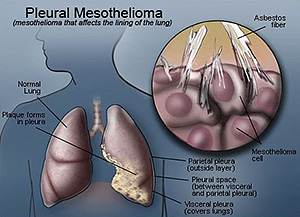Pleural Mesothelioma - Mesothelioma Claims Info Website